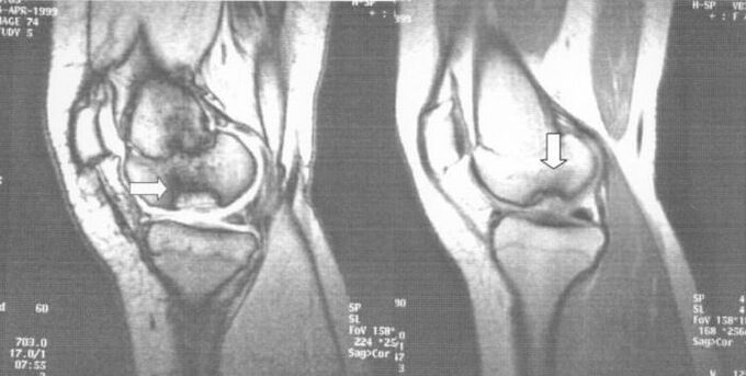 radiography of osteochondrosis dissecans in the knee joint
