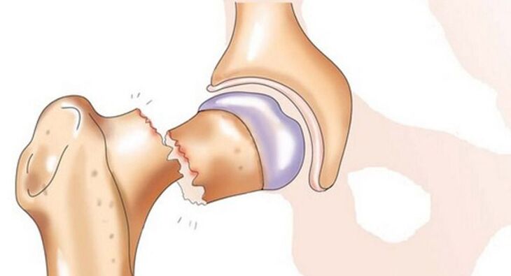 A fracture of the neck of the femur is accompanied by severe pain in the hip joint