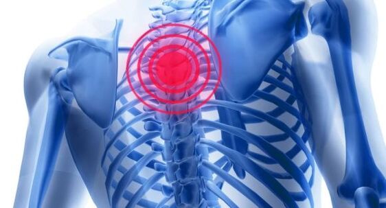 Treatment of osteocondrosis of the thoracic spine