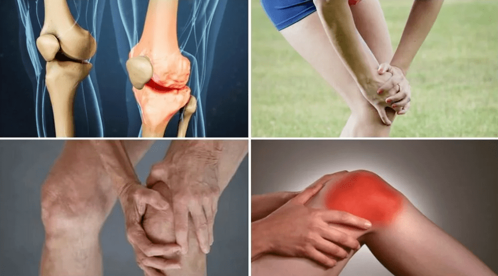 Symptoms of Artrosis