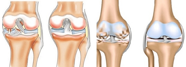 Arthritis and arthrosis