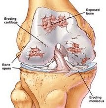 Artrosis Development Mechanism